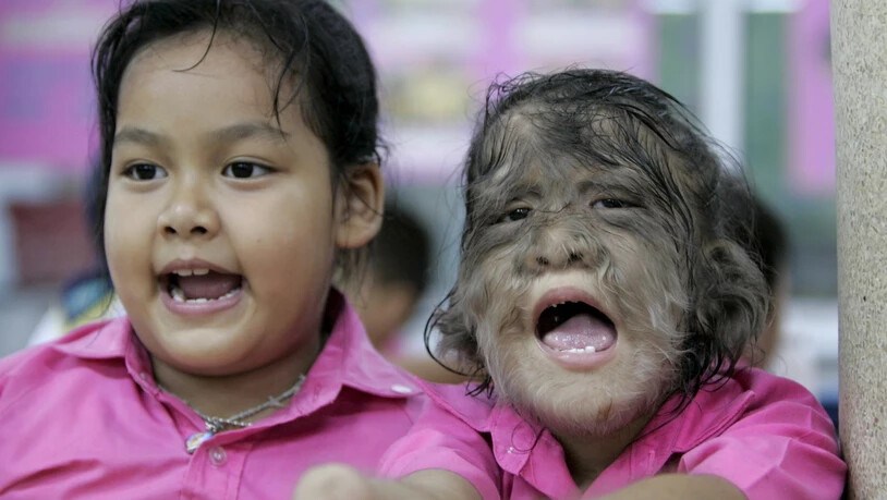 Eine Schülerin mit dem sogenannten "Werwolf-Syndrom" (Hypertrichose) in Thailand. (Archivbild)