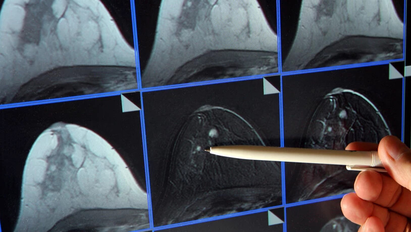 Bildschirmdarstellung einer Magnetresonanz-Mammographie. Dabei ist ein winziger Tumor in der Brust einer Patientin zu sehen. (Archivbild)