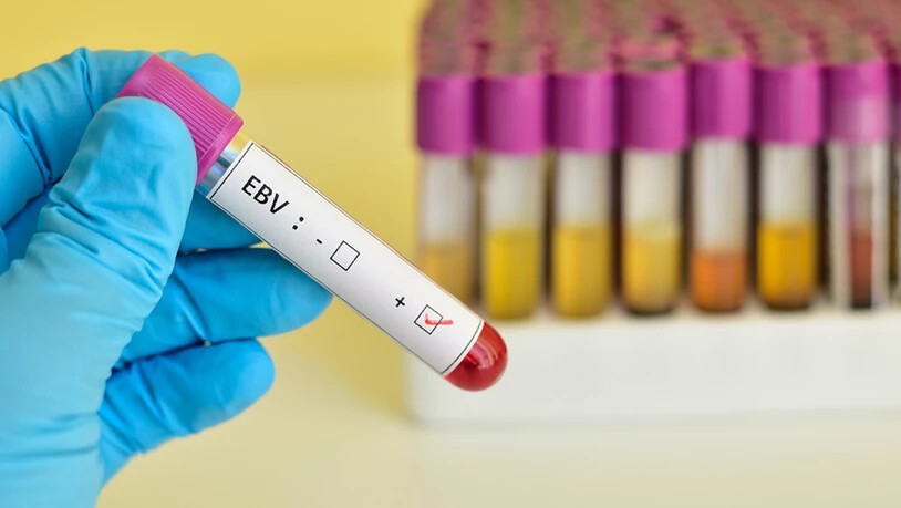 Blutprobe, die positiv auf das Epstein-Barr-Virus (EBV) getestet wurde. Sein Träger - sofern er auch über die Genvariation HLA-DR15 verfügt - ist stark gefährdet, an Multipler Sklerose zu erkranken (Bild: UZH)