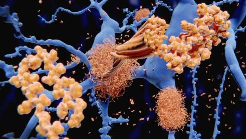 Amyloid-Beta-Plaque in den Zwischenräumen von Gehirnzellen, wie es für Alzheimer typisch ist. Bei Fruchtfliegen mit dieser Beeinträchtigung linderten Schlaf- und Epilepsiemittel die Gedächtnisprobleme (Pressebild Uni Freiburg).