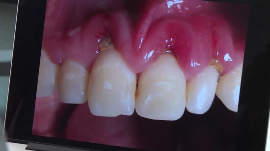 Unschöner Anblick für die Zahnärzte: Durch Snus verätzt sich das Zahnfleisch und es kommt zur Entzündung. Immer mehr solche Fälle sind bekannt.